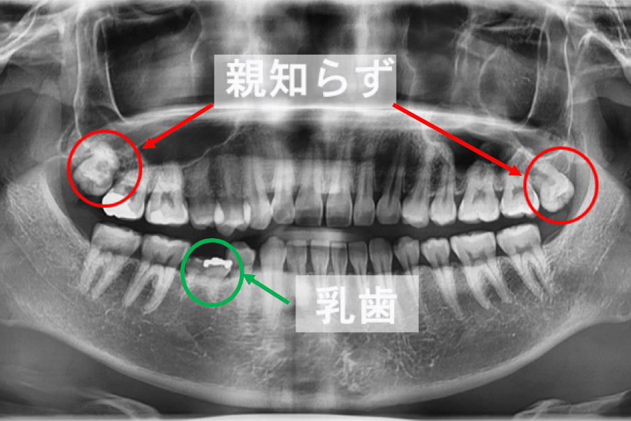 レントゲン写真