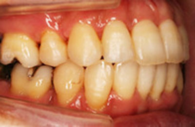 Case02 歯並びが凸凹で、口が閉じずらい 術後